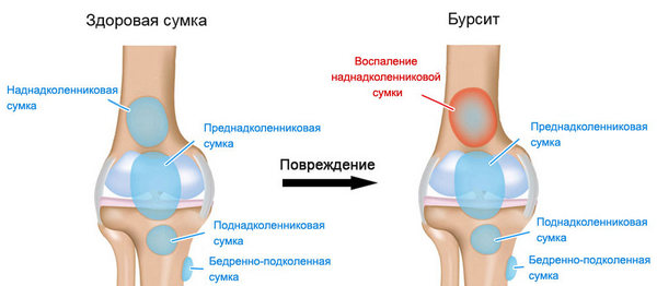 Народные методы лечения бурсита коленного сустава в домашних условиях