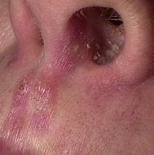 Ожог слизистой носа симптомы