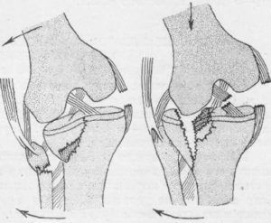 Перелом колена