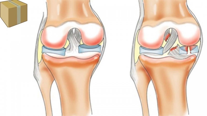Не хрустиОперация на связки коленного сустава