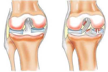 Как разработать ногу после перелома коленного сустава