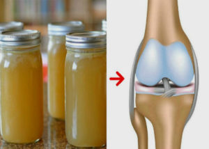 Лечение артроза коленного сустава желатином