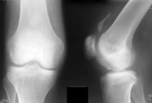 Почему в коленных суставах возникает лигаментоз, симптоматика и лечение болезни