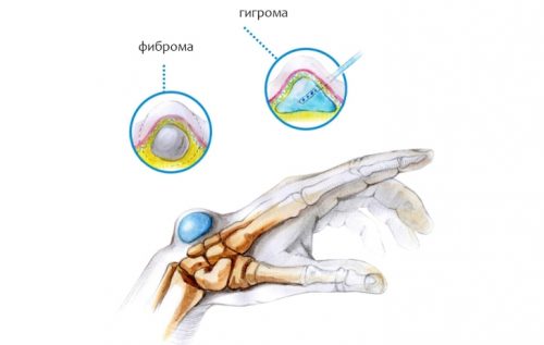 Шишки на суставах пальцев рук причины, симптомы и лечение
