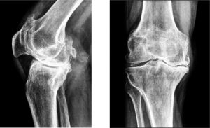 Лечение полиартрита колена традиционными и народными методами