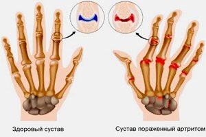 Народные средства от артрита пальцев рук