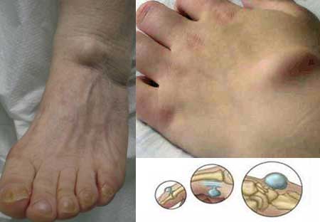 Стадии развития и особенности лечения гигромы коленного сустава